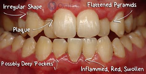 How To Recognize Gum Disease What Do Normal Healthy Gums Look Like