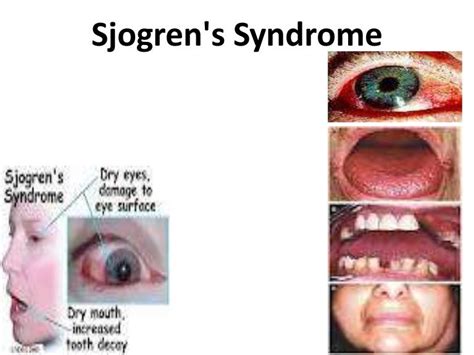 Sjögren Sendromu Hasta Yorumları Kizil Ocak