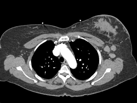 Left Breast Cancer With Axillary Adenopathy Chest Case Studies