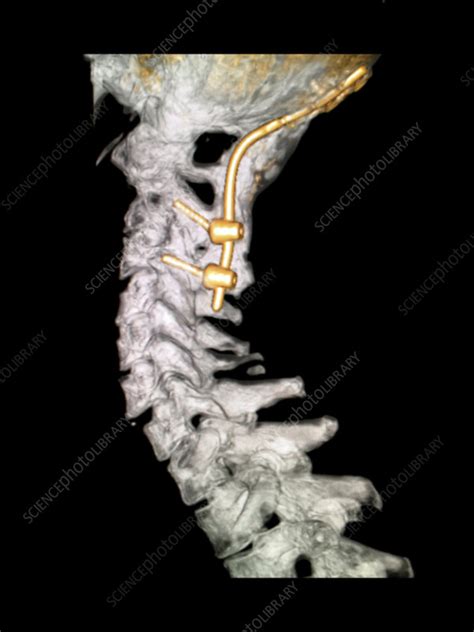 Occipital Cervical Fusion 3d Ct Stock Image C0430215 Science