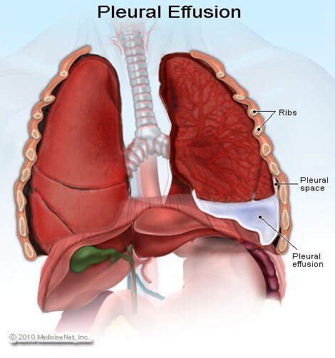 Causes of pleural effusion are generally from another illness like liver disease, congestive heart. Definition of Fetal pleural effusion