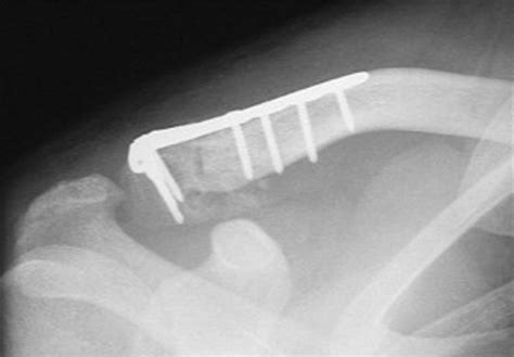 Clavicle Shaft Fractures Trauma