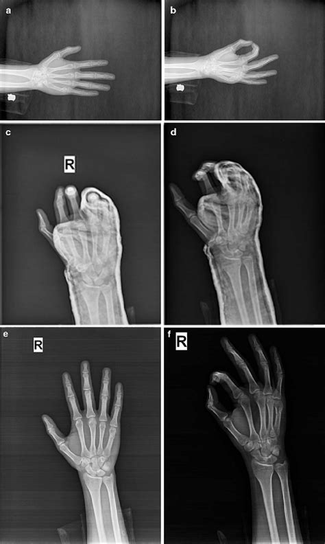 A Ap Radiograph Image Of Right Hand Fifth Metacarpal Neck Fracture
