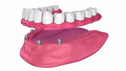 Implants Dental Hollywood West Cost October