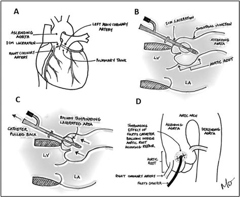 Illustration Demonstrating A Anterior Site Of Aortic Root Injury B
