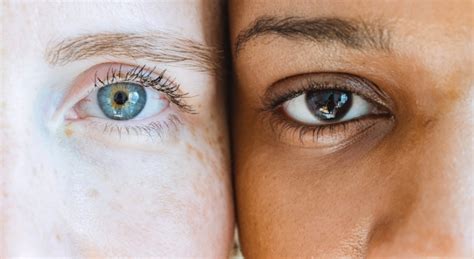 All About Heterochromia Silicon Valley Eye Physicians