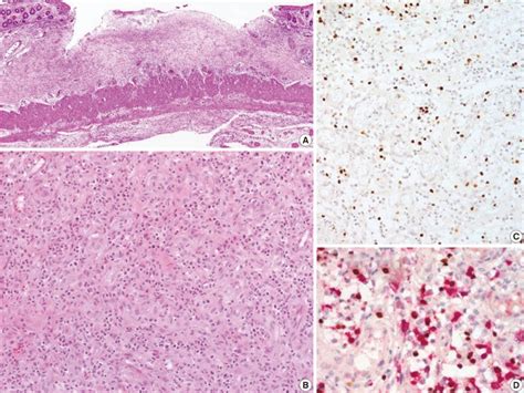 Chronic Active Epstein Barr Virus Ebv Infection Table 2 Patient 5