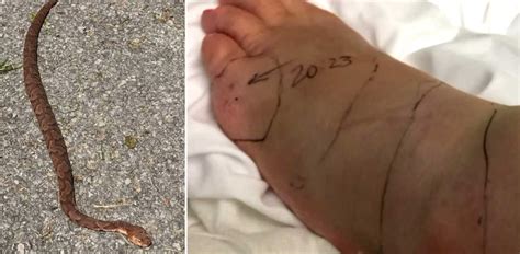 Mom Is Bitten 3 Times By Copperhead In Front Of Restaurant
