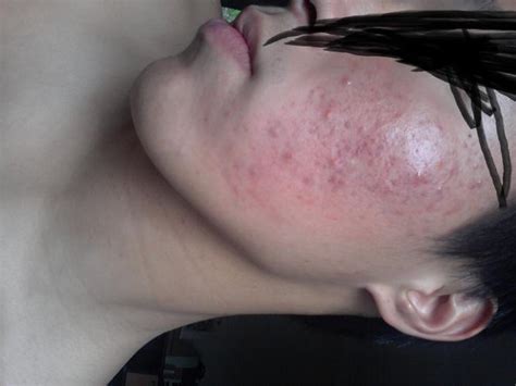 Severe Acne On Cheeks Scarring Scar Treatments By