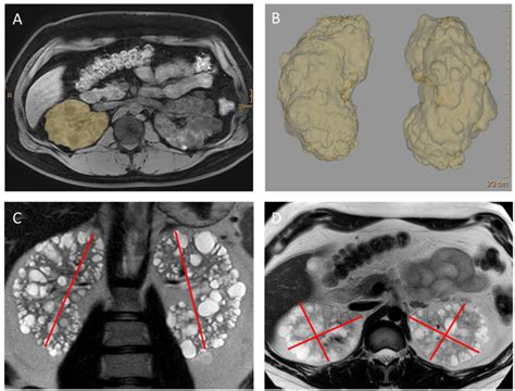 Mri Imaging And Volumetry Of Kidneys In Autosomal Dominant Polycystic