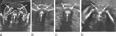 Fetal Spine Anatomy Ultrasound