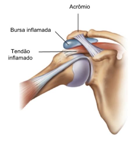Quiropraxia Osteopatia Com Acupuntura Em Franca Sp Dor No Ombro