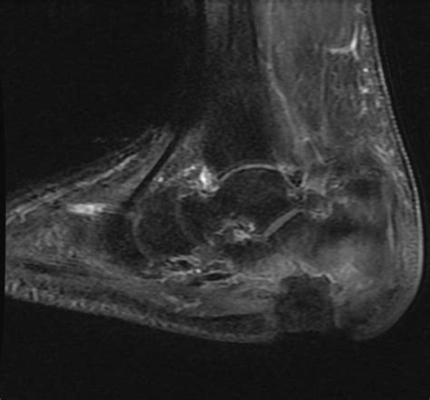 Osteomyelitis Imaging Findings Wikidoc