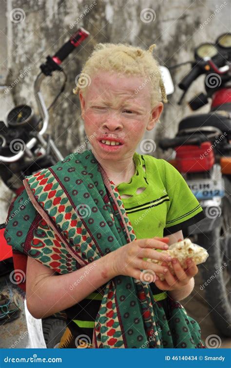 Africa Albinos Children Portrait Editorial Stock Image Image 46140434