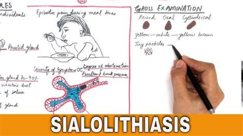 Sialolithiasis Salivary Stones Pathogenesis Clinical Features
