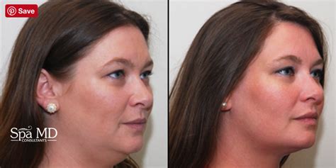 Kybella Destroys Fat Cells And Unwanted Double Chin