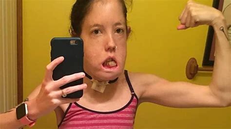 Woman Born With Rare Cyst Condition Defies Odds Becomes Disability