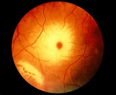 Tay Sachs Disease Retina Image Bank