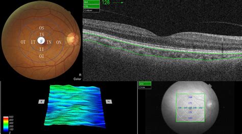 The Swept Source Optical Coherence Tomography Ss Oct Provides The