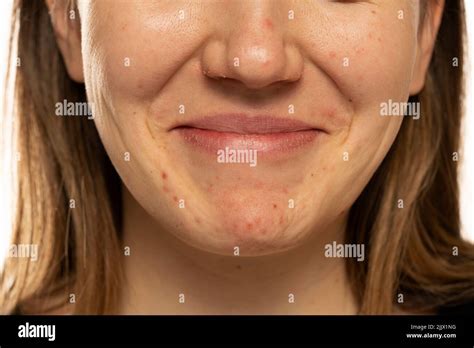 Young Smiling Woman With The Pimples On Her Face Problematic Skin