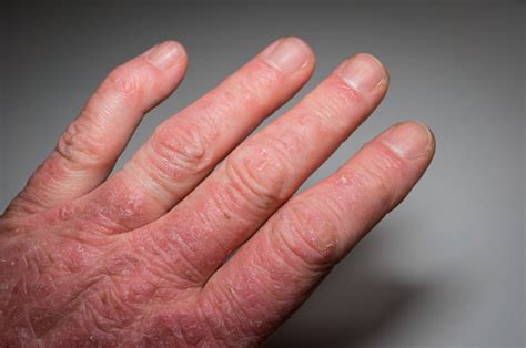 Hand Of A Psoriasis Patient Closeup Psoriatic Arthritis Joint