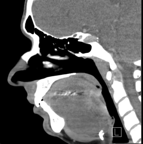 Floor Of Mouth Dermoid Cyst Eurorad