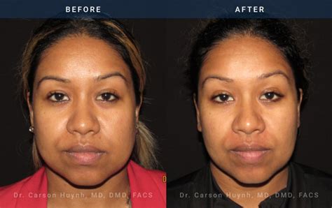 Buccal Fat Reduction Atlanta Ga Radiance Surgery And Aesthetic Medicine