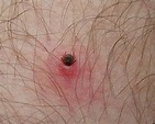 WARNING: Man BITTEN BY TICK DIES DAYS LATER From NEW DISEASE That Has ...