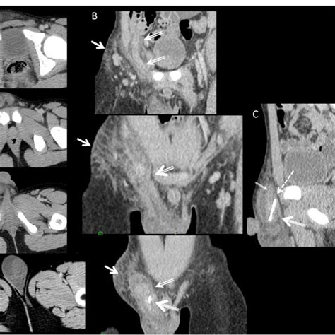 A Successive Axial Ct Images From The Inguinal Canal To The Scrotum