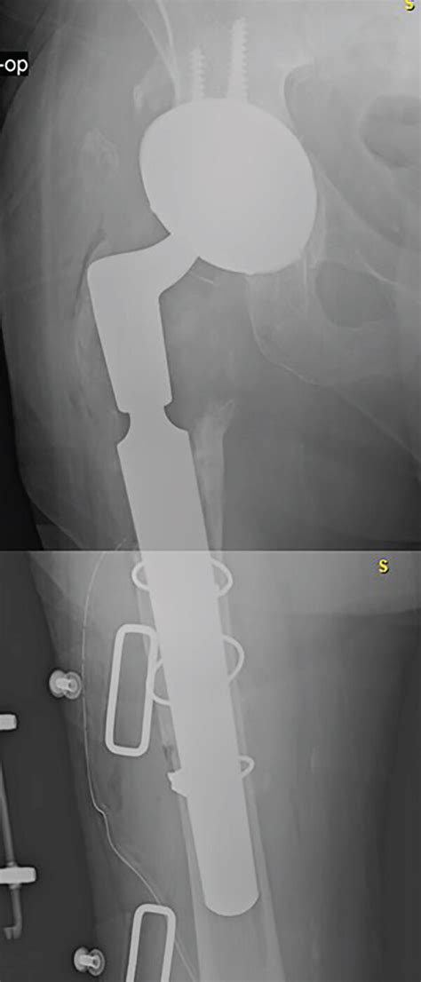 Anteroposterior X Ray Of The Right Hip After Reimplantation Before