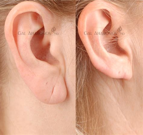Otoplasty Ear Surgery Plastic Surgery