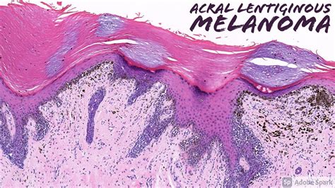 Acral Lentiginous Melanoma Dermatopathology Youtube