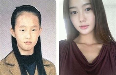 Before And After Photos Of Korean Plastic Surgery Pics Izismile Com