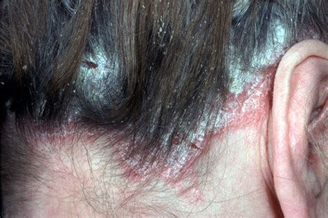 Scalp Psoriasis Adalah Seborrhoeic Dermatitis Johnny Depp Case