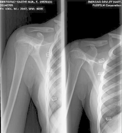 Anterior Posterior Radiograph Showing Midshaft Clavicular Fracture