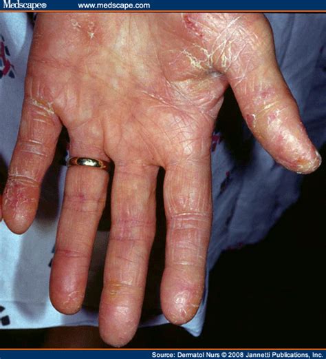 Dermatitis Of The Hand Eczema Free Skin