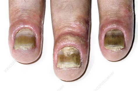 Psoriasis Of The Fingernails Stock Image C0169278 Science Photo