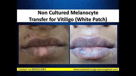 Vitiligo White Patches Cosmetic Surgery With Noncultured Melanocyte
