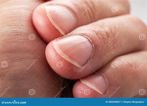 Ridged Fingernails With Vertical Ridgesnails Problems Stock Image