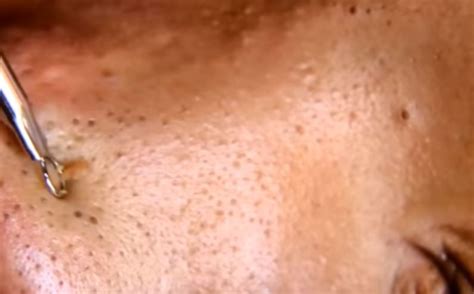 Blackheads On Cheeks Causes And Fast Removal Skincarederm