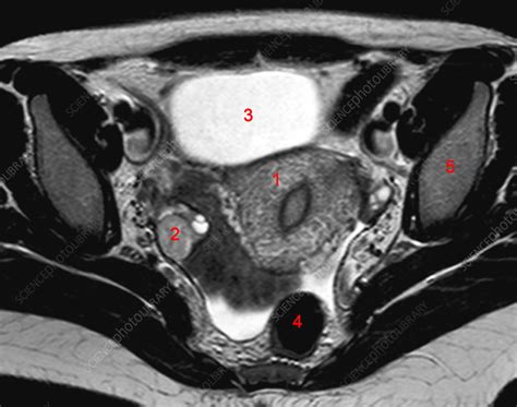 Normal Female Pelvis MRI Stock Image C026 9012 Science Photo Library