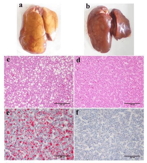 Typical Features Of Fatty Liver In Terms Of Gross Appearance And