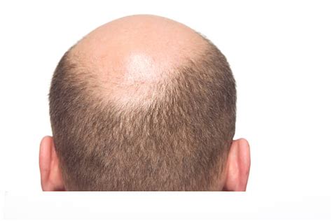 Best Bald Spot Stock Photos Pictures And Royalty Free Images Istock