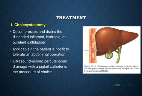 Common Bile Duct Stone