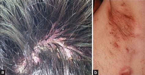 Hidradenitis Suppurativa Scalp