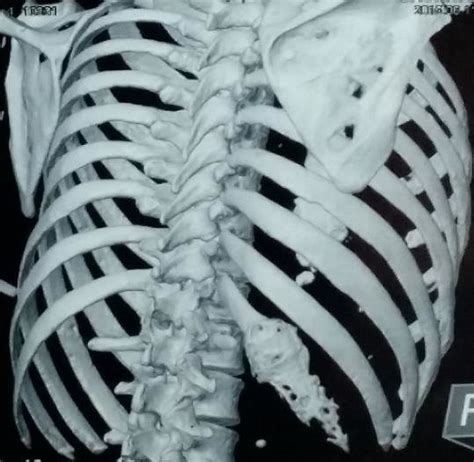 X Ray Chest Showing Expansile Lytic Lesion Of Right 12 Th Rib