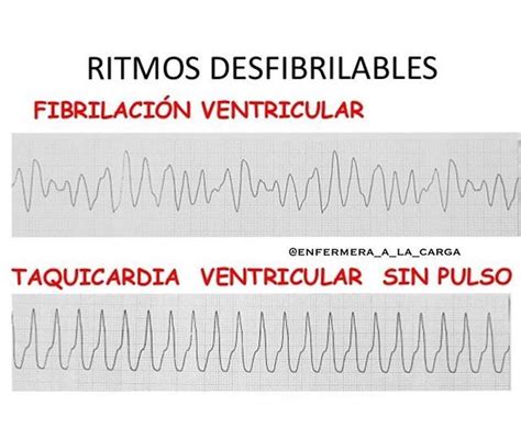 Demostrar Prueba De Derbeville Autorizar Fibrilacion Auricular