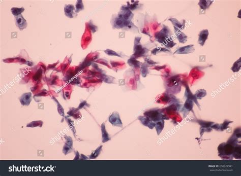 Candida Albicans Infecion Pap Smearyeast Form Stock Photo 658622941