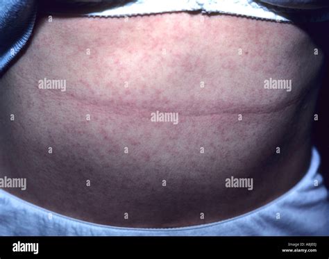 Allergic Contact Eczema Dermatitis Rash On The Patients Abdomen