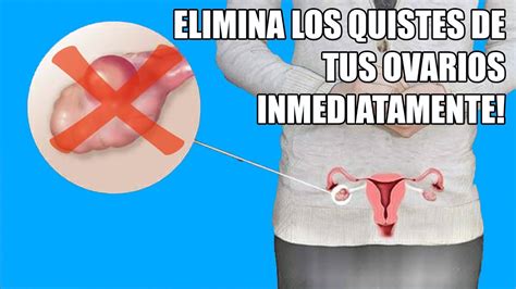 Limpia Tus Ovarios De Quistes Miomas Y Fibromas Con 1 Vaso De Remedio Casero Y Natural Youtube